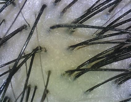 BEFORE PURIFYING dry scalp opti BEFORE PURIFYING dry scalp opti