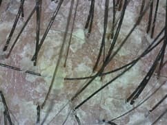 PSORIASIS SCALP PROBLEM A OPTI PSORIASIS SCALP PROBLEM A OPTI