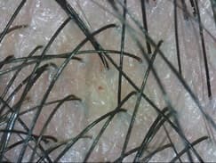PSORIASIS SCALP PROBLEM AFTER 11 DAYS B OPTI PSORIASIS SCALP PROBLEM AFTER 11 DAYS B OPTI