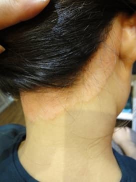 PSORIASIS SCALP PROBLEM AFTER 11 DAYS OPTI PSORIASIS SCALP PROBLEM AFTER 11 DAYS OPTI