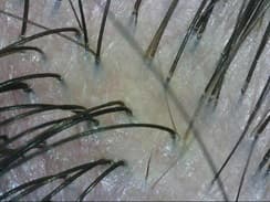 PSORIASIS SCALP PROBLEM AFTER 20 DAYS C OPTI PSORIASIS SCALP PROBLEM AFTER 20 DAYS C OPTI