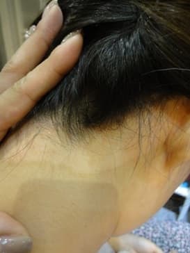 PSORIASIS SCALP PROBLEM AFTER 20 DAYS OPTI PSORIASIS SCALP PROBLEM AFTER 20 DAYS OPTI