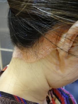 PSORIASIS SCALP PROBLEM OPTI SORIASIS SCALP PROBLEM OPTI
