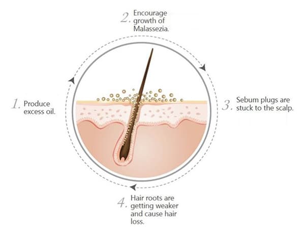 Dry scalp problems-hide-the-secretin your hair Dry scalp problems-hide-the-secretin your hair